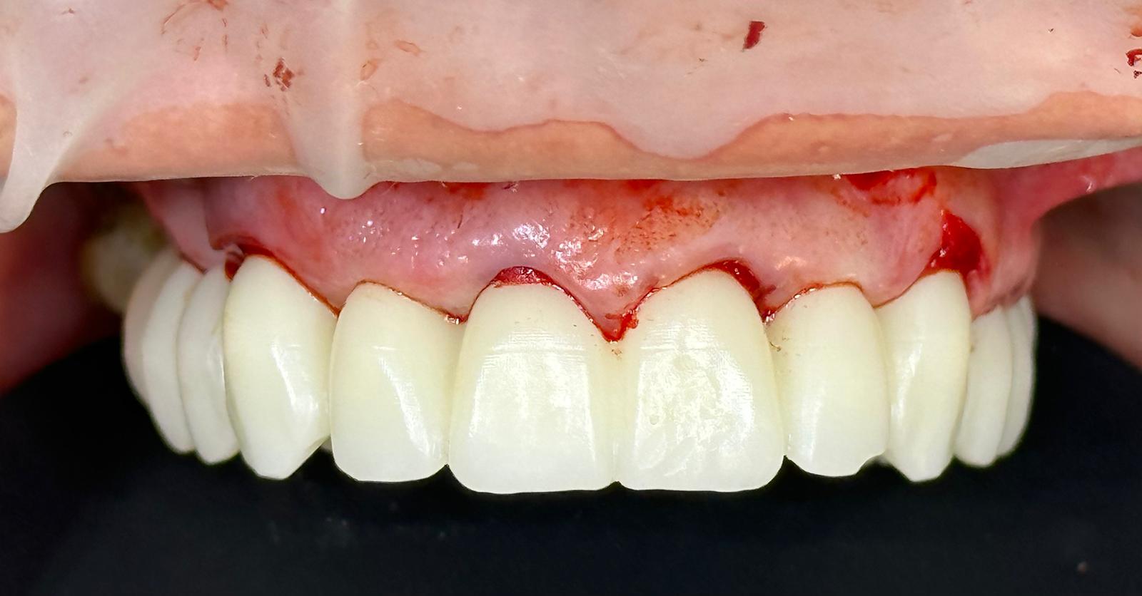 A Comprehensive Look at PMMA Dental Applications - CeraDirect